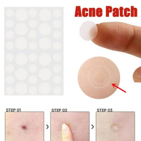 Acne patch