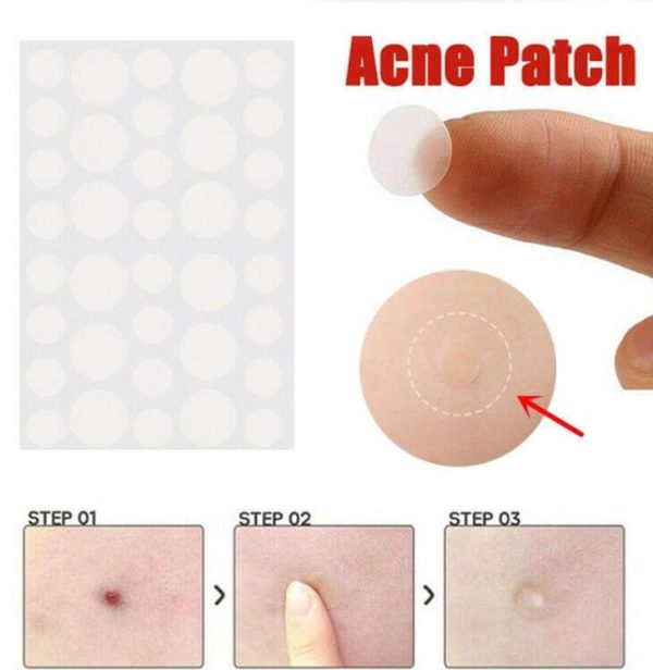 Acne patch